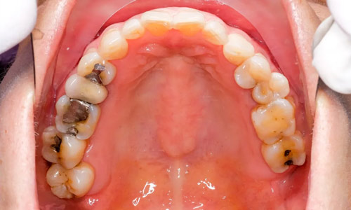 Having holes in the teeth can be restored using dental fillings at the top dental clinic in Gurgaon