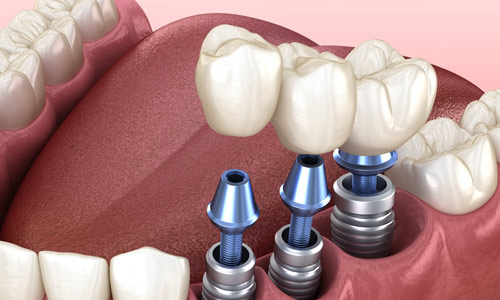 For the permanent artificial tooth, get the dental implant treatment in Gurgaon and get the crown placed after the treatment
