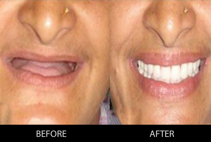 See the results of dental implants as installed by the best dentist in Gurgaon, where the lady having no teeth has a bright white smile.