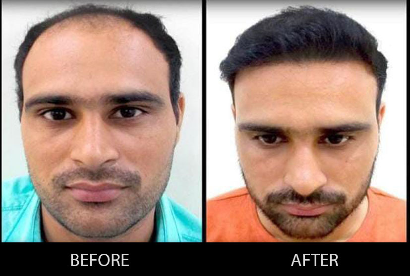 The doctor here will remove your baldness and provide the proper hair transplant in Gurgaon to enhance your visual appearance.