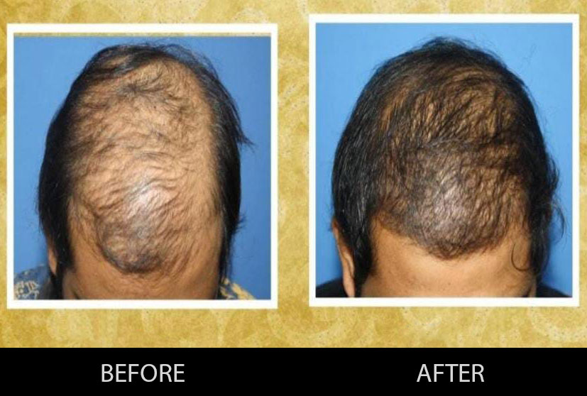 Grow your hair and remove baldness through Hair Transplant in Gurgaon at Irvin Cosmetics and get visible results.