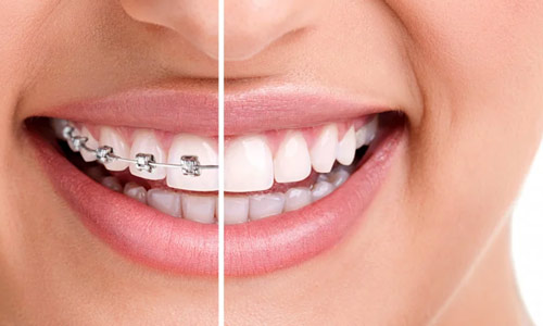 The best cosmetic dentist in Gurgaon uses all types of dental braces and delivers you the best orthodontic treatment
