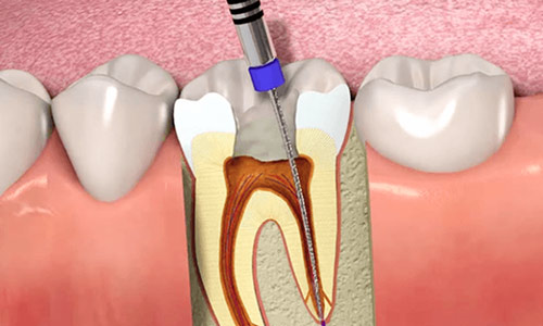 With the best Dentist in Gurgaon, you can get rid of cavities through Root Canal Treatment in Gurgaon