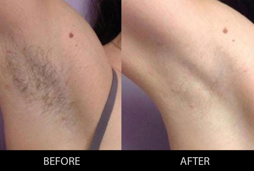 It is the best skin care clinic in Gurgaon, where through Laser Hair Removal Treatment in Gurgaon, you can easily get rid of unwanted body hairs.